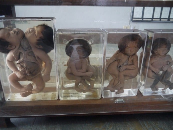 Conjoined Twins At Congdon Anatomical Museum, Bangkok
