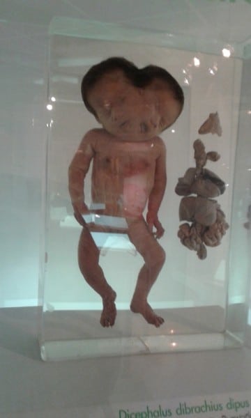A Baby With Two Heads A Baby With Two Heads