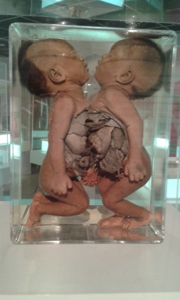 Conjoined Twins Showing Internal Organs