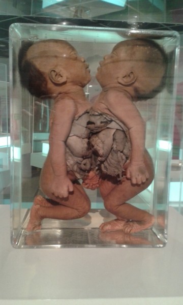 Conjoined Twins Showing Internal Organs Conjoined Twins Showing Internal Organs