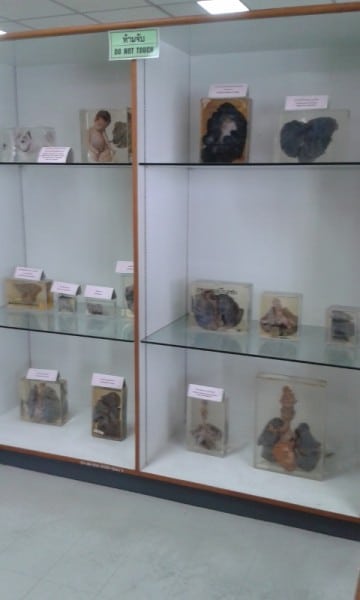 Displays At The Forensic Museum, Bangkok Displays At The Forensic Museum, Bangkok